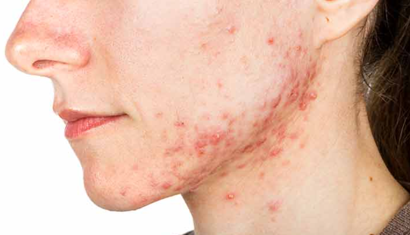 An illustration depicting the causes of acne.