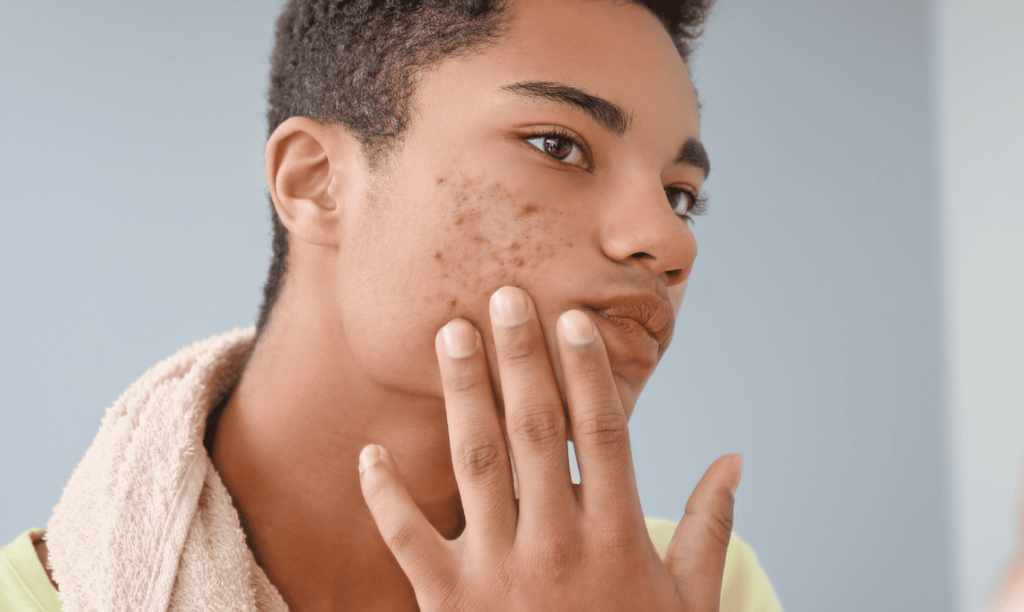environmental-factors-and-acne
