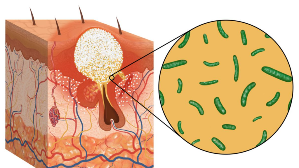 The Role of Bacteria in Acne - Understanding the impact of microbial balance on skin health.