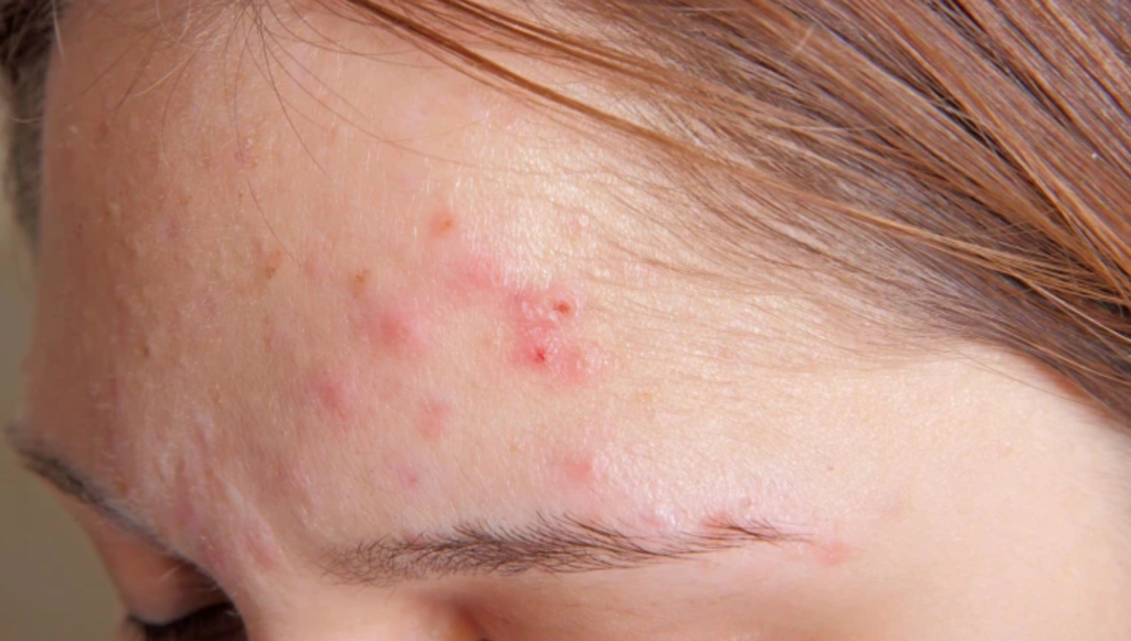 Understanding Acne: A Skin Dilemma - Unveiling Clear Skin Secrets

