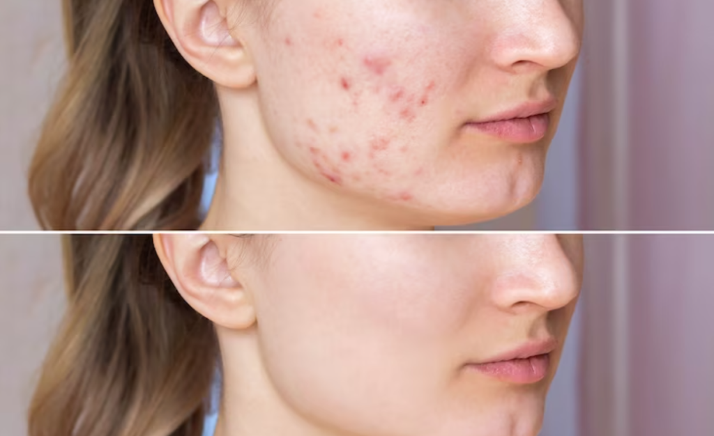 A clear, radiant complexion symbolizing the benefits of comprehensive acne care, as detailed in "The Definitive Guide to Acne: Everything You Need to Know for Blemish Care and Beyond.