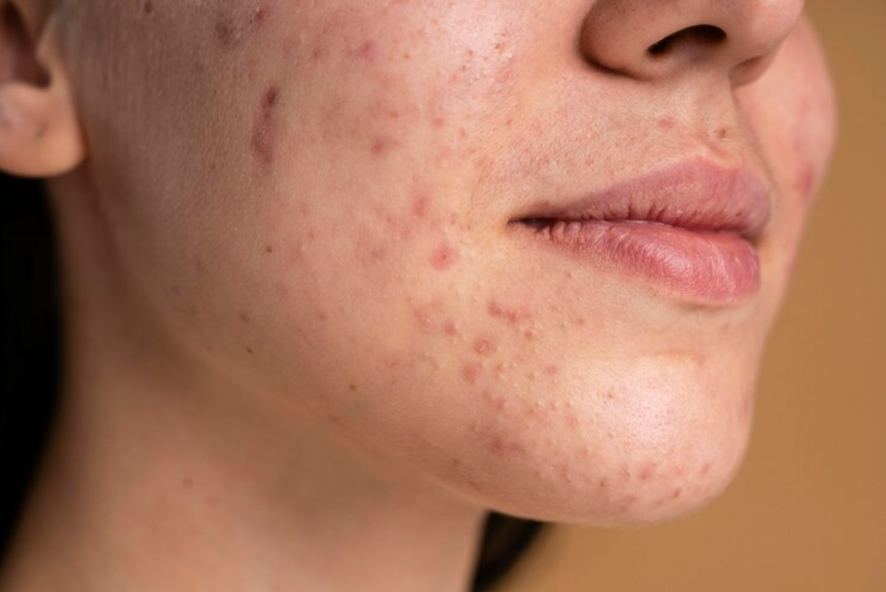 Reduced Acne Solutions" - an image depicting clear and healthy skin.